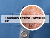 上海银屑病哪家医院看的好 上海市银屑病哪家好