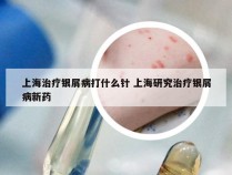 上海治疗银屑病打什么针 上海研究治疗银屑病新药