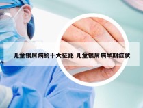 儿童银屑病的十大征兆 儿童银屑病早期症状