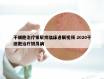 干细胞治疗银屑病临床进展视频 2020干细胞治疗银屑病
