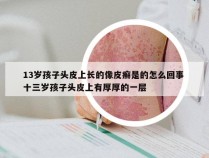 13岁孩子头皮上长的像皮癣是的怎么回事 十三岁孩子头皮上有厚厚的一层