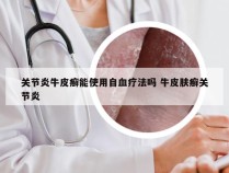 关节炎牛皮癣能使用自血疗法吗 牛皮肤癣关节炎