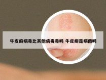 牛皮癣病毒比其他病毒毒吗 牛皮癣是病菌吗