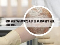 银屑病留下的黑斑怎么去淡 银屑病留下的黑印能好吗