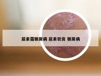 尿素霜银屑病 尿素软膏 银屑病