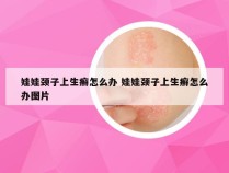 娃娃颈子上生癣怎么办 娃娃颈子上生癣怎么办图片