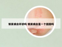 银屑病会环状吗 银屑病会是一个圆圈吗