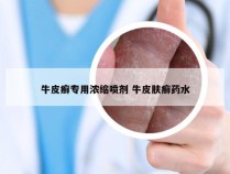 牛皮癣专用浓缩喷剂 牛皮肤癣药水