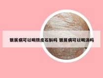 银屑病可以喝铁皮石斛吗 银屑病可以喝汤吗