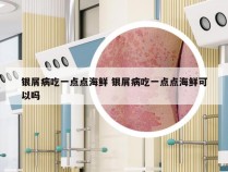 银屑病吃一点点海鲜 银屑病吃一点点海鲜可以吗