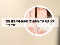 喜辽妥治疗牛皮癣吗 喜辽妥治疗皮炎多少天一个疗程