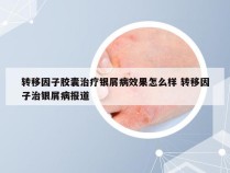 转移因子胶囊治疗银屑病效果怎么样 转移因子治银屑病报道