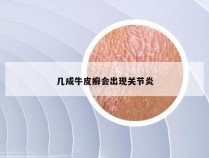 几成牛皮癣会出现关节炎