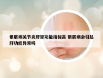 银屑病关节炎肝肾功能指标高 银屑病会引起肝功能异常吗