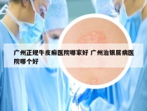 广州正规牛皮癣医院哪家好 广州治银屑病医院哪个好