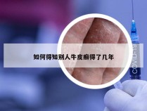 如何得知别人牛皮癣得了几年