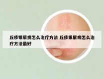 丘疹银屑病怎么治疗方法 丘疹银屑病怎么治疗方法最好