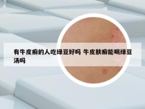 有牛皮癣的人吃绿豆好吗 牛皮肤癣能喝绿豆汤吗