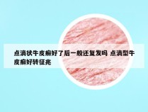 点滴状牛皮癣好了后一般还复发吗 点滴型牛皮癣好转征兆