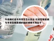 牛皮癣红皮与寻常型怎么区分 红皮型银屑病与寻常型银屑病的组织病理不同在于