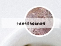 牛皮癣有没有痊愈的案例