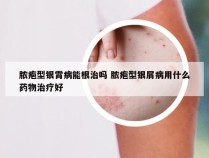 脓疱型银霄病能根治吗 脓疱型银屑病用什么药物治疗好