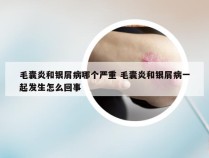 毛囊炎和银屑病哪个严重 毛囊炎和银屑病一起发生怎么回事