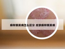 癣和银屑病怎么区分 皮肤癣和银屑病