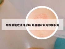 银屑病能吃活珠子吗 银屑病可以吃珍珠粉吗