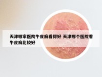 天津哪家医院牛皮癣看得好 天津哪个医院看牛皮癣比较好