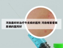 河南最好的治疗牛皮癣的医院 河南哪里看银屑病的医院好
