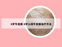 8岁牛皮癣 8岁小孩牛皮癣治疗方法