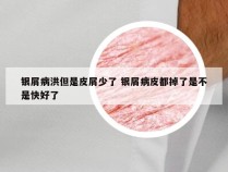 银屑病洪但是皮屑少了 银屑病皮都掉了是不是快好了