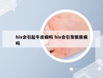 hiv会引起牛皮癣吗 hiv会引发银屑病吗