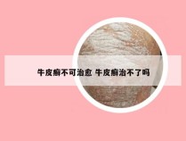 牛皮癣不可治愈 牛皮癣治不了吗