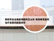 衡阳专业治银屑病医院怎么样 衡阳哪家医院治疗皮肤问题最有效