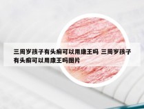 三周岁孩子有头癣可以用康王吗 三周岁孩子有头癣可以用康王吗图片