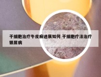 干细胞治疗牛皮癣进展如何 干细胞疗法治疗银屑病