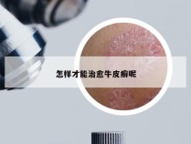 怎样才能治愈牛皮癣呢