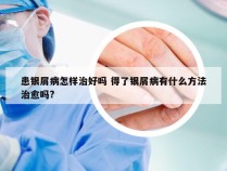 患银屑病怎样治好吗 得了银屑病有什么方法治愈吗?
