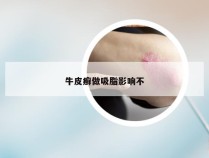 牛皮癣做吸脂影响不