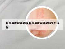 银屑病有误诊的吗 银屑病有误诊的吗怎么治疗