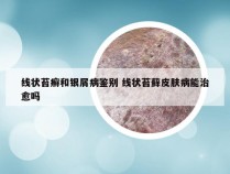 线状苔癣和银屑病鉴别 线状苔藓皮肤病能治愈吗
