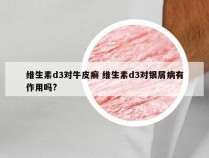 维生素d3对牛皮癣 维生素d3对银屑病有作用吗?