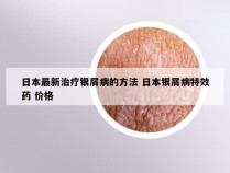 日本最新治疗银屑病的方法 日本银屑病特效药 价格