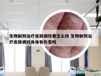 生物制剂治疗皮肤病效果怎么样 生物制剂治疗皮肤病对身体有伤害吗