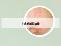 牛皮癣感染途径