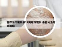 善存治疗银屑病12例疗效观察 善存片治疗银屑病