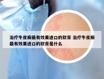 治疗牛皮癣最有效果进口的软膏 治疗牛皮癣最有效果进口的软膏是什么