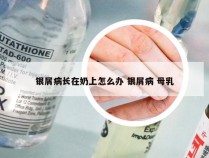 银屑病长在奶上怎么办 银屑病 母乳
